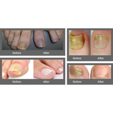 No Miss - Antifungal Fungus Treatment (Set 6 Boxes)